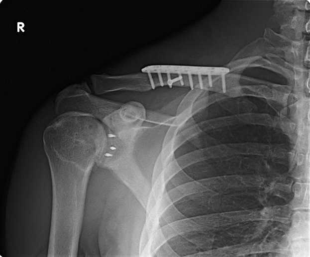 How To Repair A Broken Clavicle