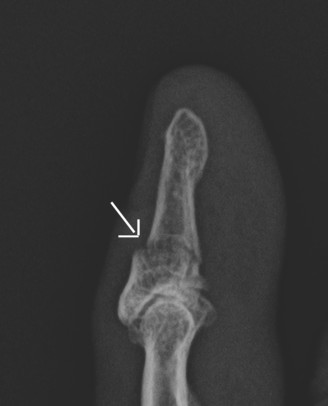 Finger x-ray