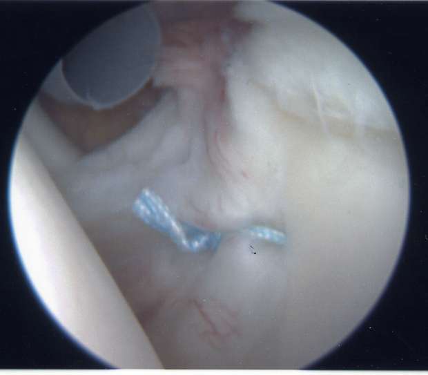 Stitched Labrum