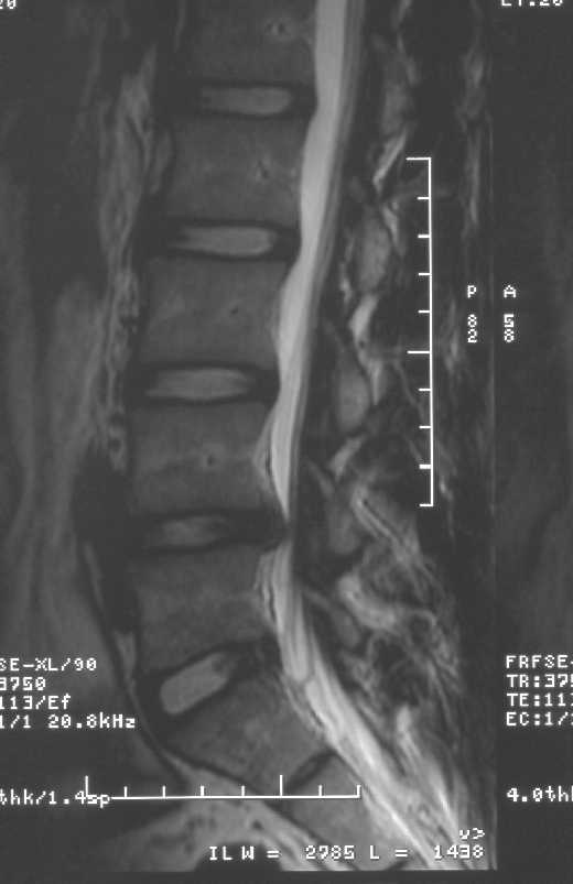 MRI of Derek's back